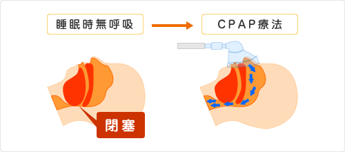 CPAP療法